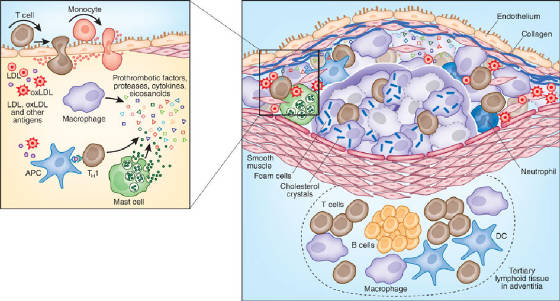 Atherogenesis & Myocardial Infarction: The Mechanism